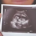 Should I Get an Early PregnancyScan?