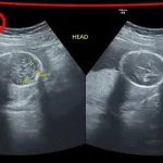 What Do the 3 Lines on a Pregnancy Ultrasound Scan Mean?