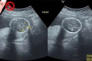 What Do the 3 Lines on a Pregnancy Ultrasound Scan Mean?