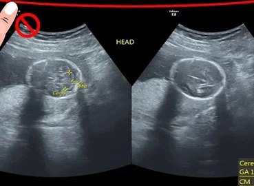 What Do the 3 Lines on Apregnancy Ultrasound ScanMean?