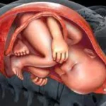 What is Anterior Placenta?