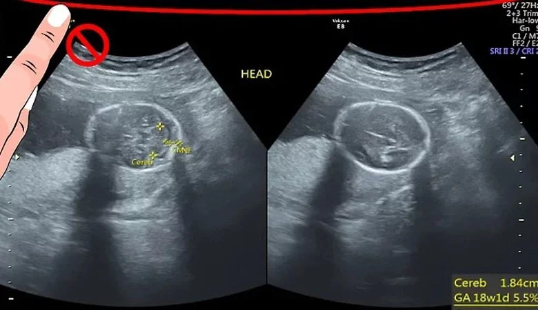 What Do the Three Lines on A Pregnancy Ultrasound Scan